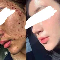 بوتاکس طبیعی در پوست