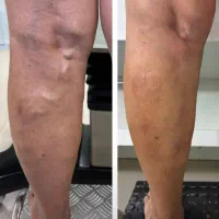 درمان فوق تخصصی واریس