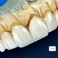 آموزش پودر (پرسلن)گذاری لیرینگ