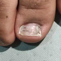 آموزش ناخن تو گوشت و ناخن قارچی و پدیکور اسپا