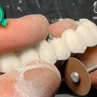 کاشت ایمپلنت دندان دیجیتال یه روزه فقط 13900