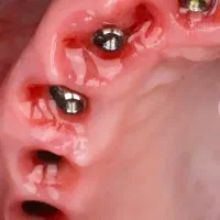 کاشت تخصصی ایمپلنت کره درجه یک