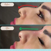 بازسازی فرم صورت در یک جلسه با فیلر وژل