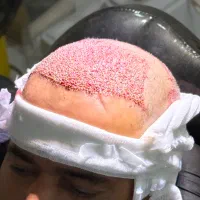 کاشت مو و ابرو بدون برش و جراحی