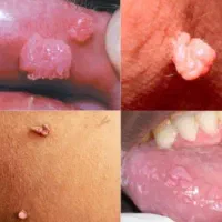 از بین بردن زگیل تناسلی