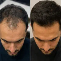 ریشه رو تقویت کن،ریزش رو قطع کن