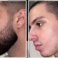 رویش طبیعی ریش بدون دردسر