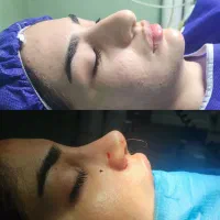 جراحی بینی فقط ۳۵تومن