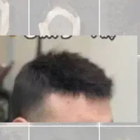 پروتز مو مردانه