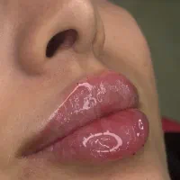 تزریق ژل و بوتاکس