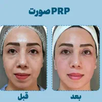 پی ار پی /مزو تراپی