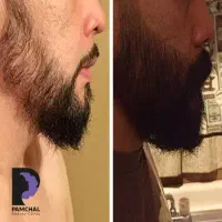 رویش ریش و سبیل و مو