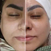 تخفیف فشیال/ فیشال /کربوکسی/مزو