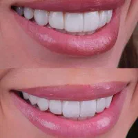 بیمه دندانپزشکی با تخفیف ویژه (اقساطی) در مراغه