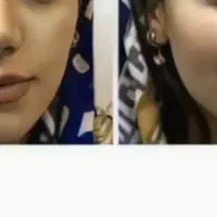 پک درمانی تپلی صورت صدردصد تضمینی گیاهی