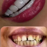 تخفیف ویژه کامپوزیت دندان با گارانتی۵۰٪تخفیف