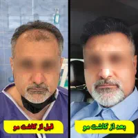 کاشت تخصصی مو و ریش و ابرو (توسط تیم شیرازی)