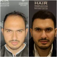 کاشت مو تبریز الماس