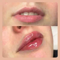 بوتاکس مصپورت تزریق فیلرلب،فیلرصورت مزوجوانسازو مو