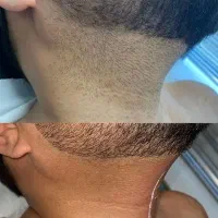 لیزر موی زائدبا دستگاه شاتی با بیشترین ریزش تضمینی