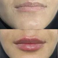 آفر مزو prp بوتاکس ژل لب زاویه فک