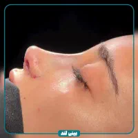 تخفیفات جراحی بینی