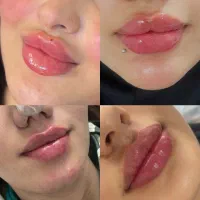 آفر ژل و بوتاکس آمپول لاغری تضمینی تزریق فیلر بادی