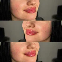 آموزش فیلر و بوتاکس و مزوژل