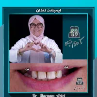 پایتخت ایمپلنت دندان/ دندانپزشکی با رضایتمندی بالا