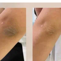 روشن شدن نواحی تیره بدن