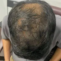 بمب رویش مجدد