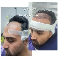 کاشت مو|خدمات آرایشگری و زیبایی|تهران, حصار بوعلی|دیوار