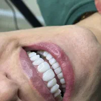 مرکز دندانپزشکی زیبایی کامپوزیت/ایمپلنت