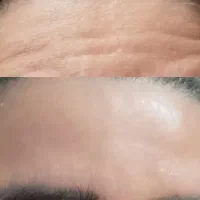 تزریقات زیبایی ژل ، بوتاکس. ، ،