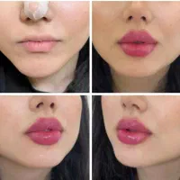 تزریق ژل و بوتاکس
