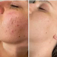 جوش های پوستی با این راهکار رفع میشه..