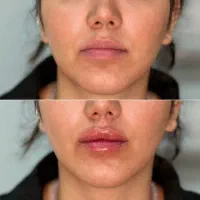 ژل بوتاکس لیزر مزوتراپی پاکسازی جوانساز فلکه‌گاز