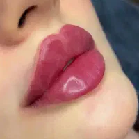 آفر ویژه تزریق فیلر لب و بوتاکس .لب نچرال رایگان
