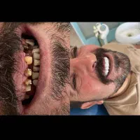 جشنواره بهاره کامپوزیت لمینت