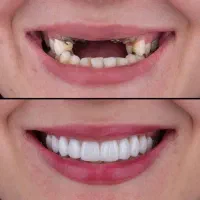 روکش دندان سرامیکی