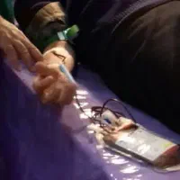 فصد خون (غلظت خون) و حجامت