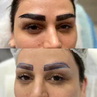 جشنواره کاشت ابرو-کاشت مو-کاشت شقیقه