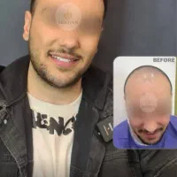 جشنواره‌کاشت‌مو(VIP)۲۲تومن کاشت ابرو۱۴‌(اقساطی)