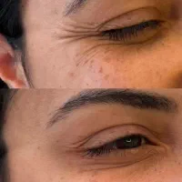 بوتاکس فیلر ۹۵۰