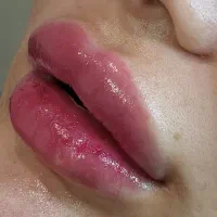 ژل و بوتاکس