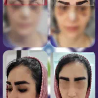 کاشت مو با ۴۲٪ کاهش هزینه با ضمانت نامه کتبی
