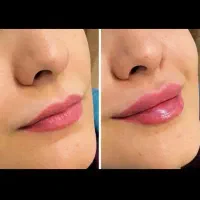 پزشک لاغری فیلر بوتاکس/ prp ۵۹۰ لیزر فول ۳۹۰ مزوژل