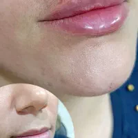 فیلرلب ،گونه ،چانه ،بوتاکس