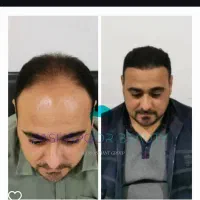 کاشت مو super fue
