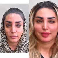 جشنواره طلایی انواع ژل،فیلر،بوتاکس،انواع لیفت صورت